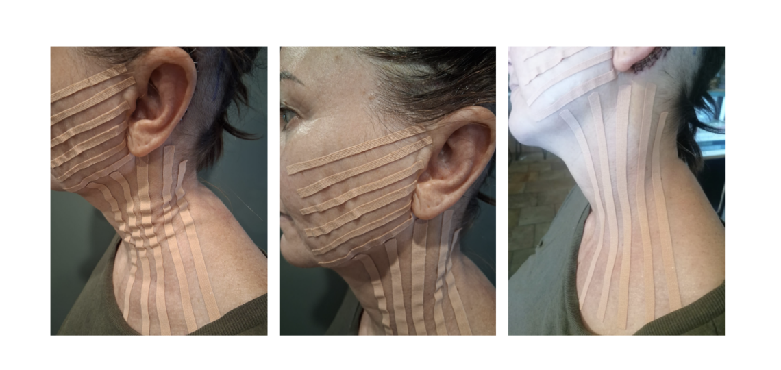 Applicazione NeuroMuscular Taping impianto cocleare nella regione post-chirurgica