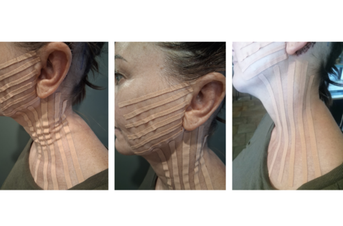 Applicazione NeuroMuscular Taping impianto cocleare nella regione post-chirurgica